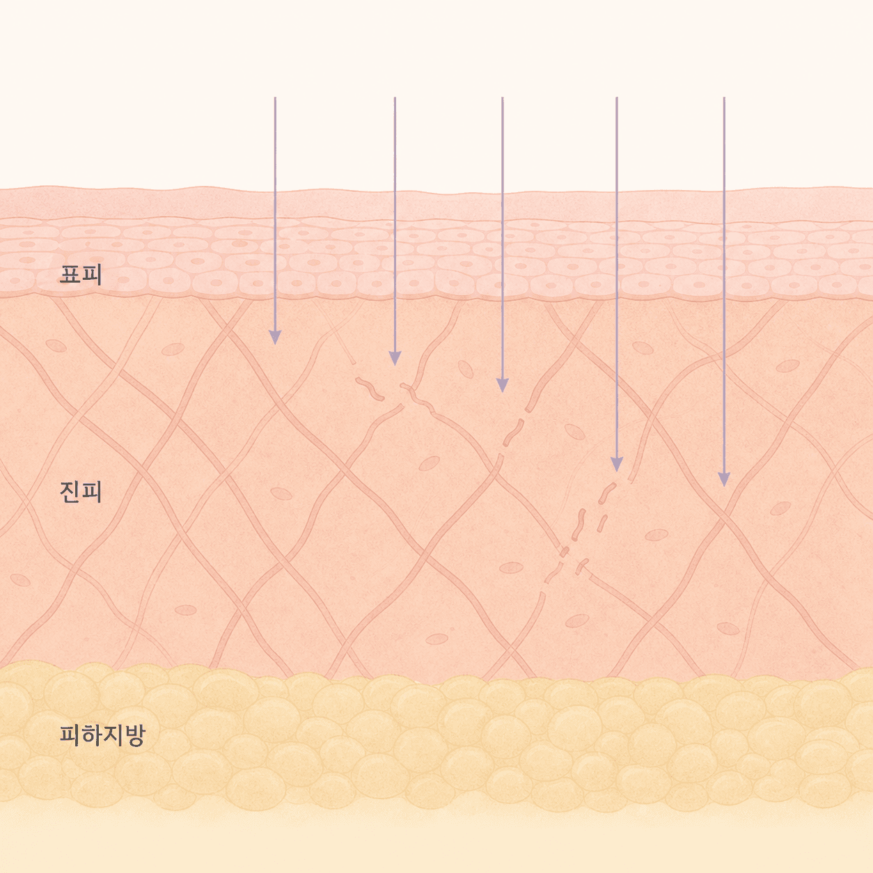 자외선이 진피에 닿아 콜라겐 그물이 끊어지는 구조