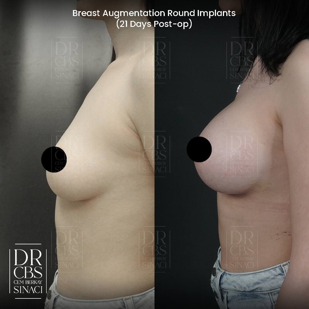 21 days result breast implant side view