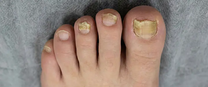 Multiple thick, discolored nails