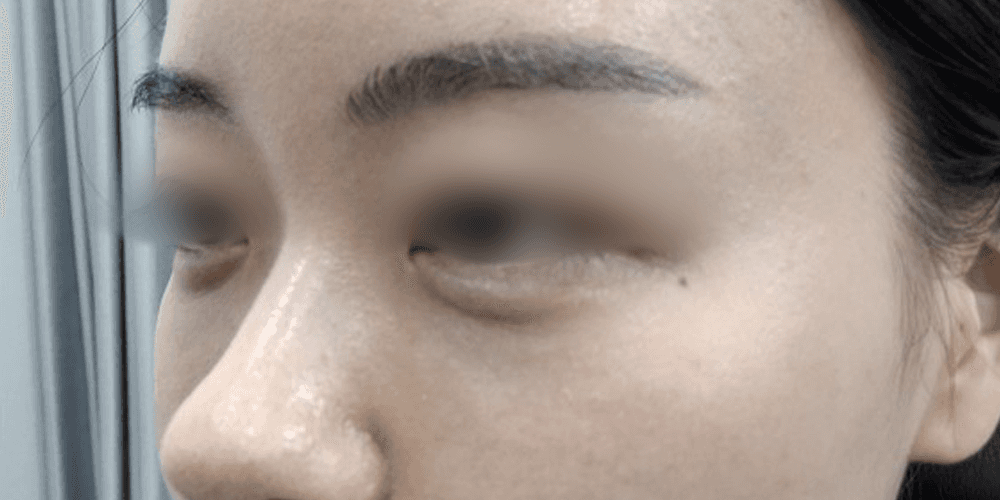 Undereye Filler - After
