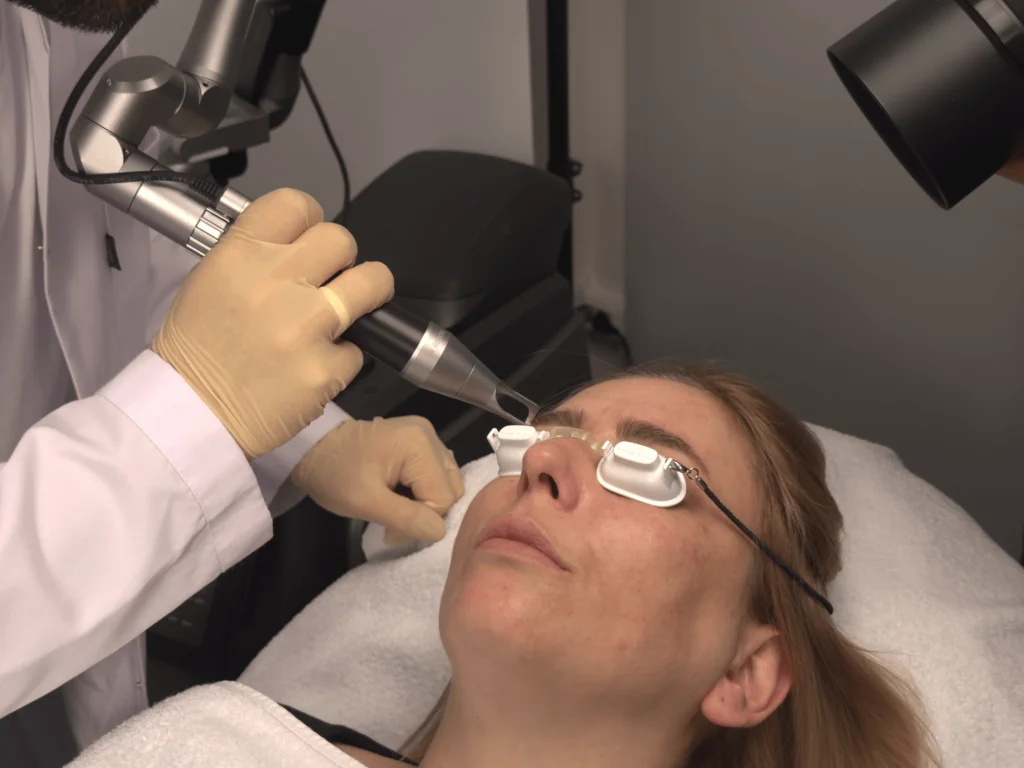 PMU-Entfernung – Activa Laserzentrum