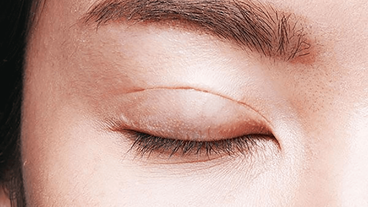 Dấu hiệu nhấn mí bị tuột chỉ 