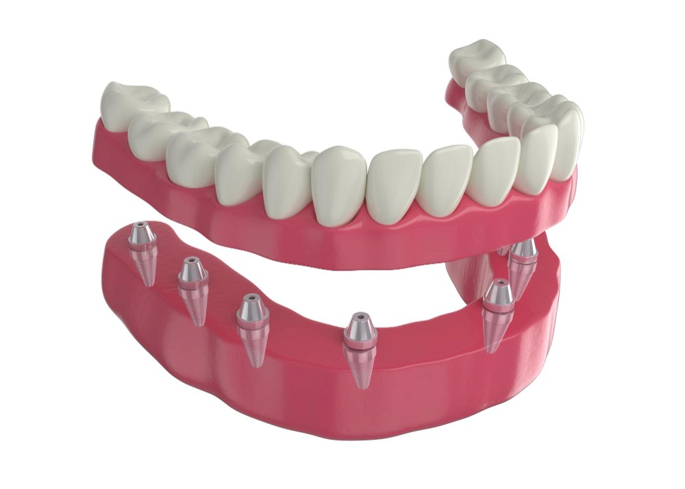 Implant-Retained Dentures Paramus