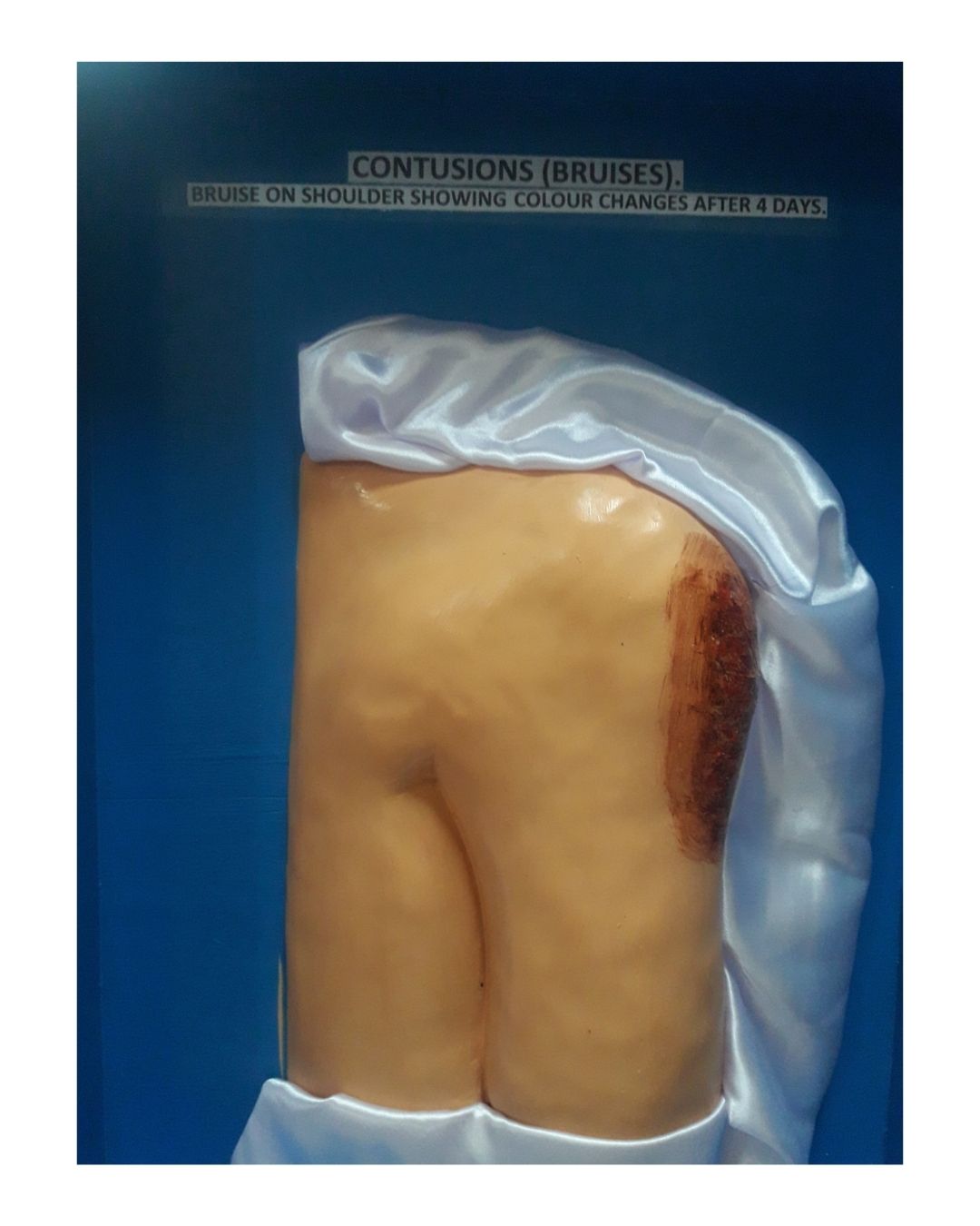 Contusion on Shoulder (Colour Change After 4 Days)