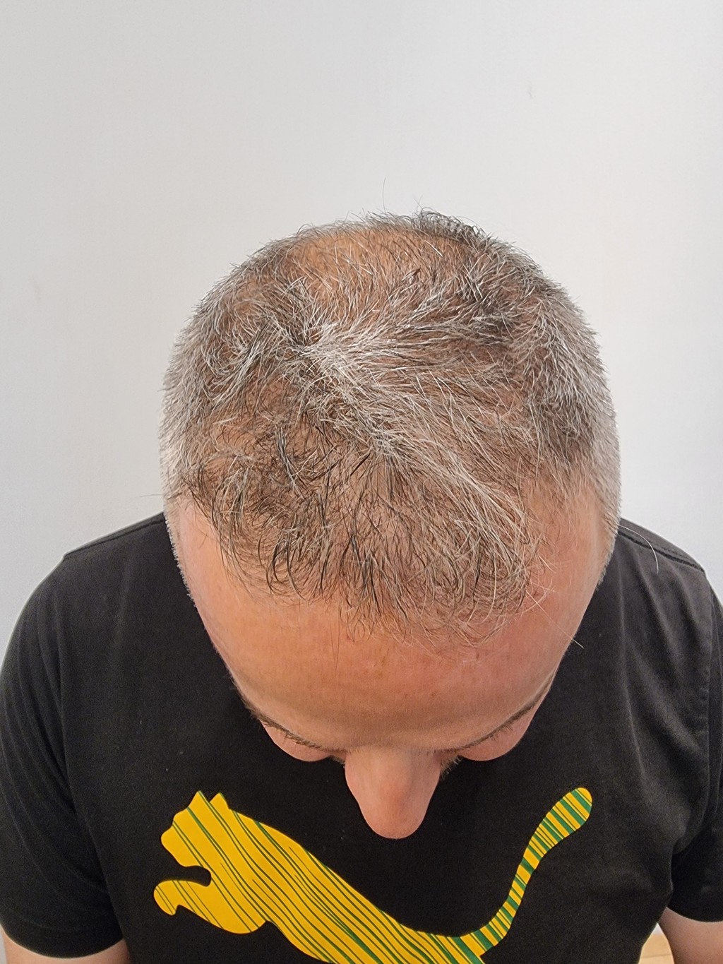 Micro haar pigmentatie Alluris