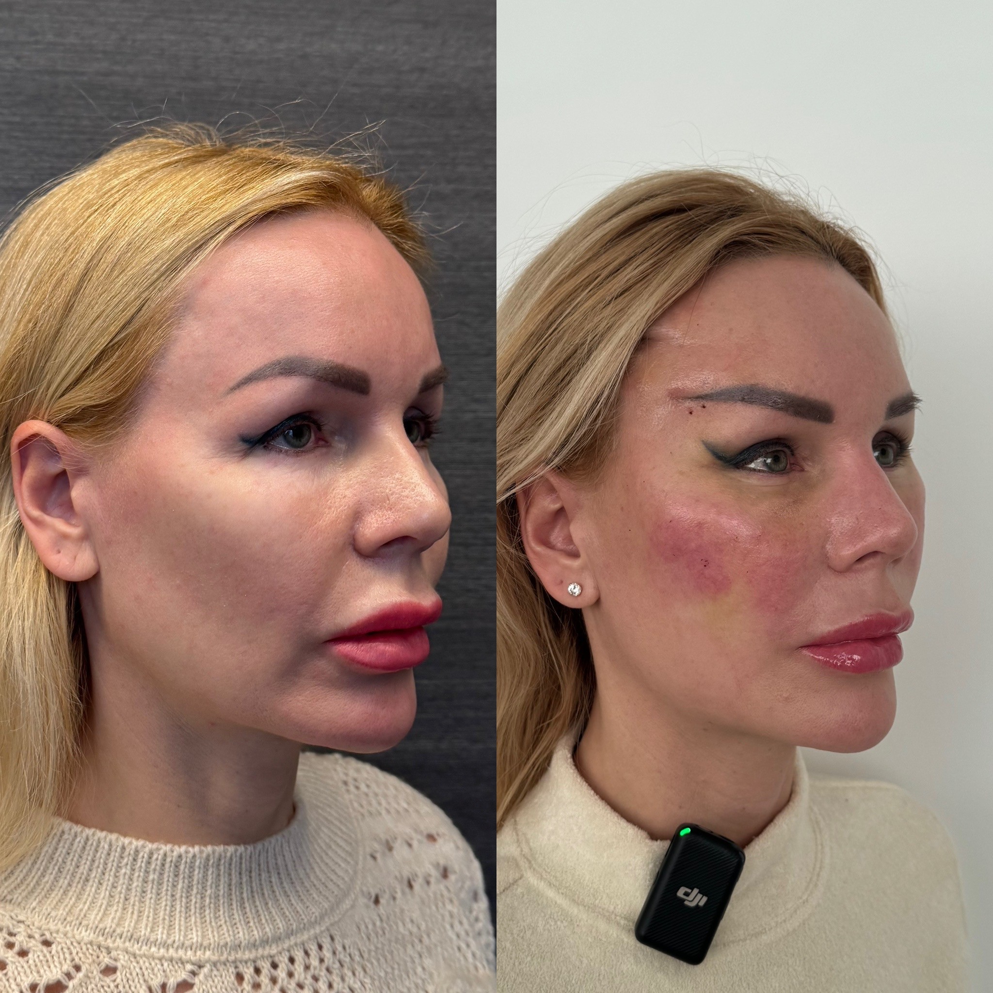 6 days before after photo of temporal face brow lift right oblique view