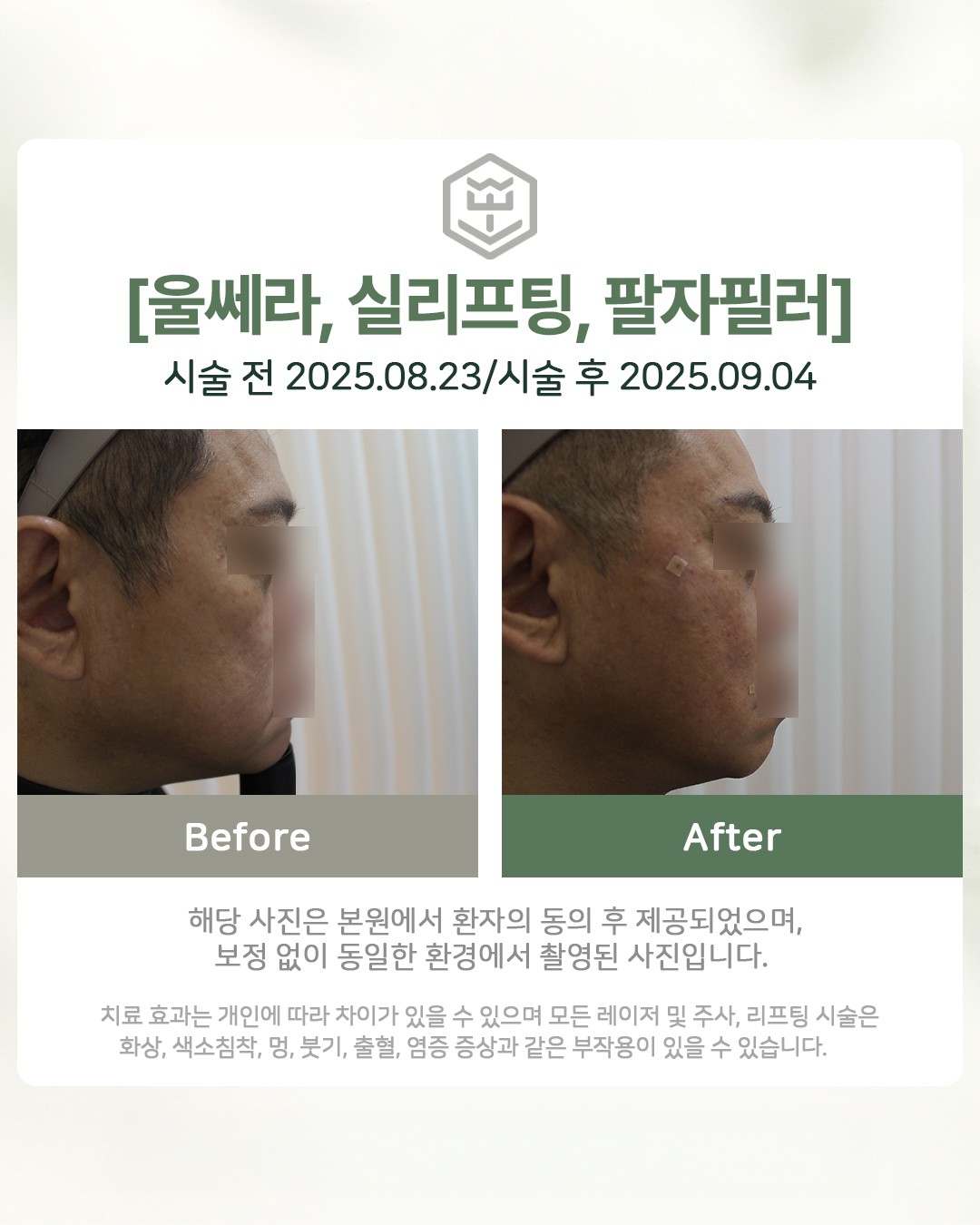 울쎄라+실리프팅+팔자필러