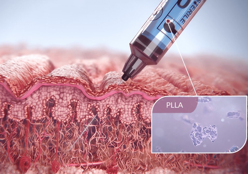 sculptra plla injection