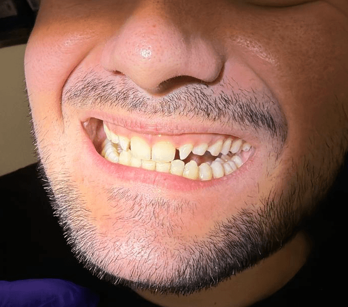 Before treatment