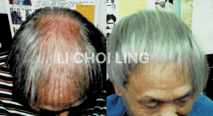 lichoiling casestudy