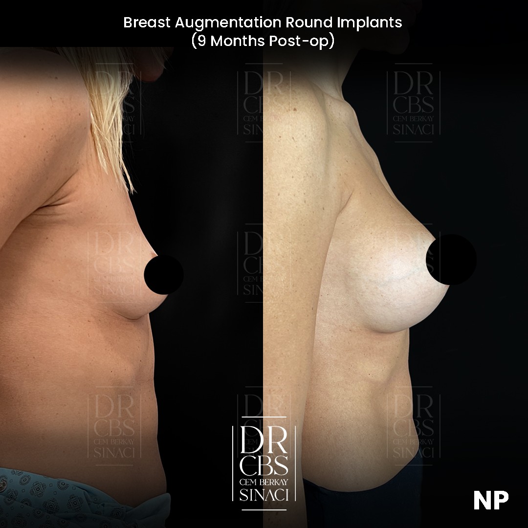 breast implant before after result right oblique view