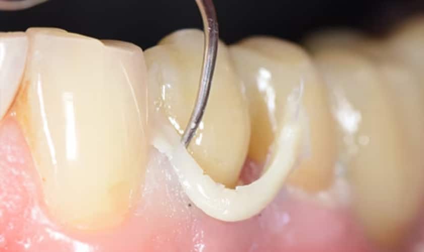 A simple cementation method to prevent material extrusion into the periimplant tissues | Bloor-Yorkville Periodontics