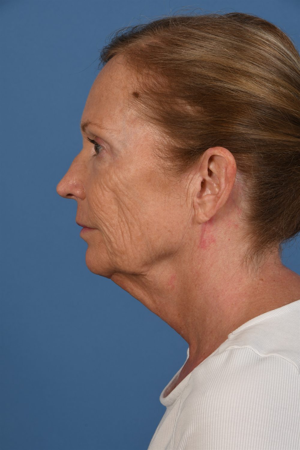 Facelift patient before surgery, profile, left side