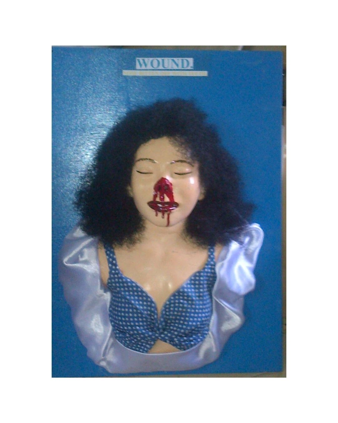 Wound (Nasal and Mouth Bleeding)