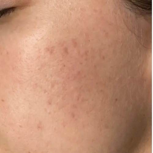 After microneedling acne scar treatment at The Vancouver Aesthetician — pitted acne scars and marks visibly gone and skin surface smoothed