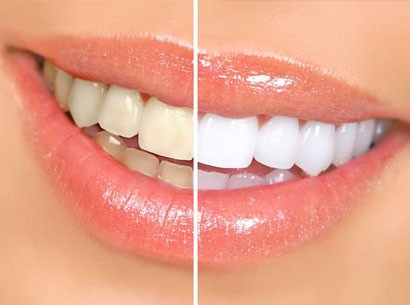 veneers