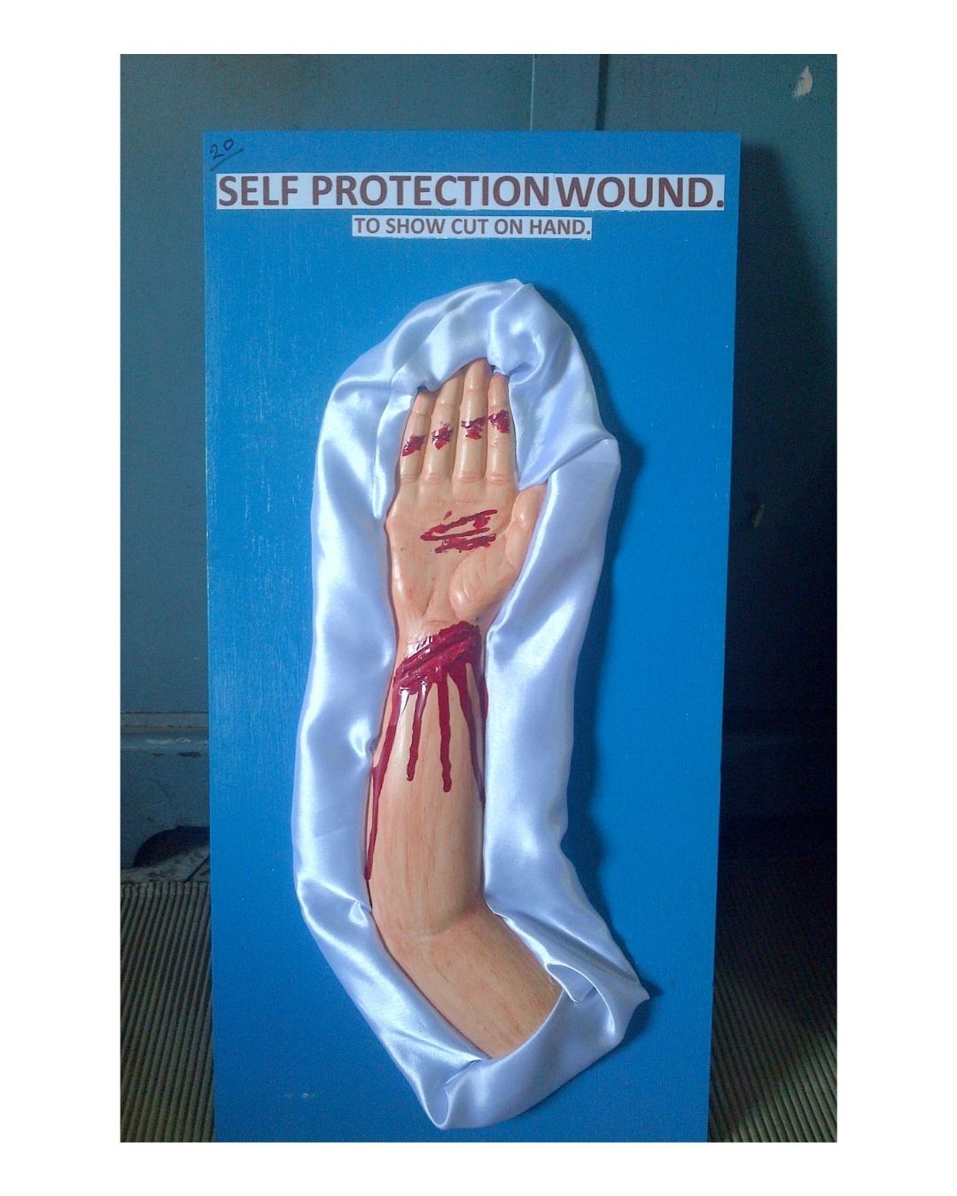 Self-Protection Wound (Cuts on Hand)