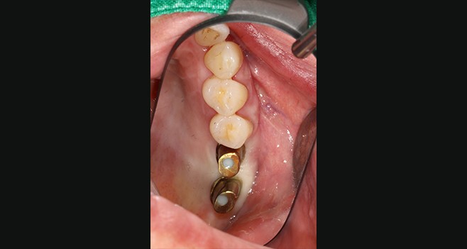 26,27 커스텀 장착