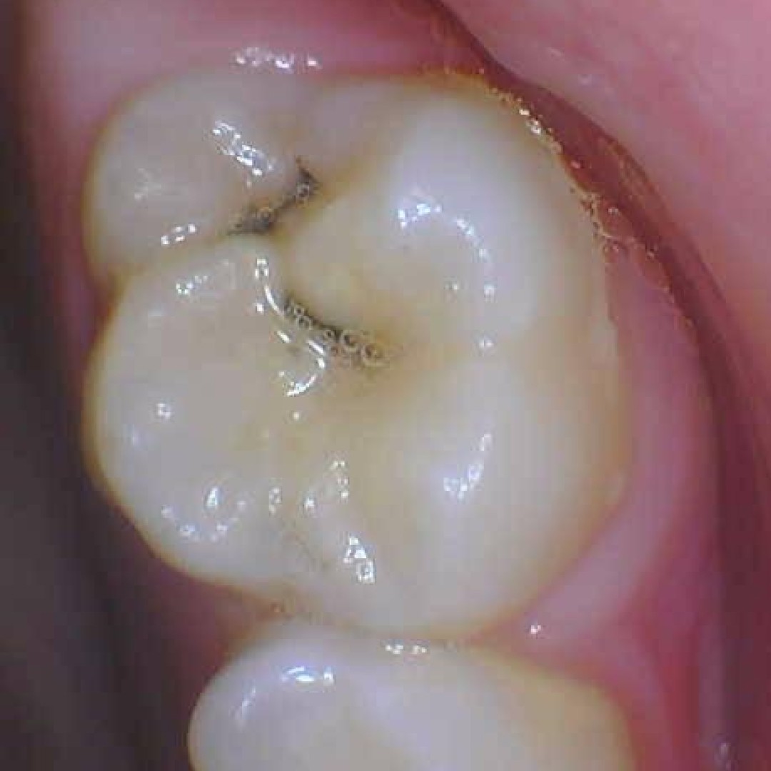 Close-up of a child’s molar treated with Silver Diamine Fluoride (SDF) to stop cavity progression without drilling.