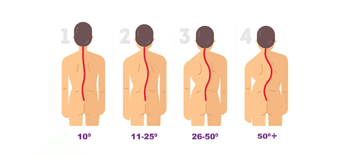 scoliosis