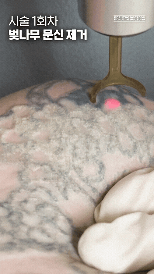 합정 문신제거, 피코가 무조건 정답일까? "잉크 깊이 모르면 헛수고입니다"