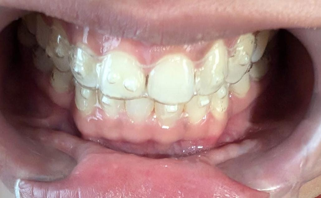 Clear aligners image