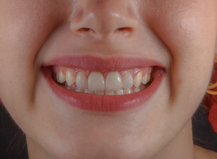 Before treatment: crooked, overlapping front teeth, unretouched