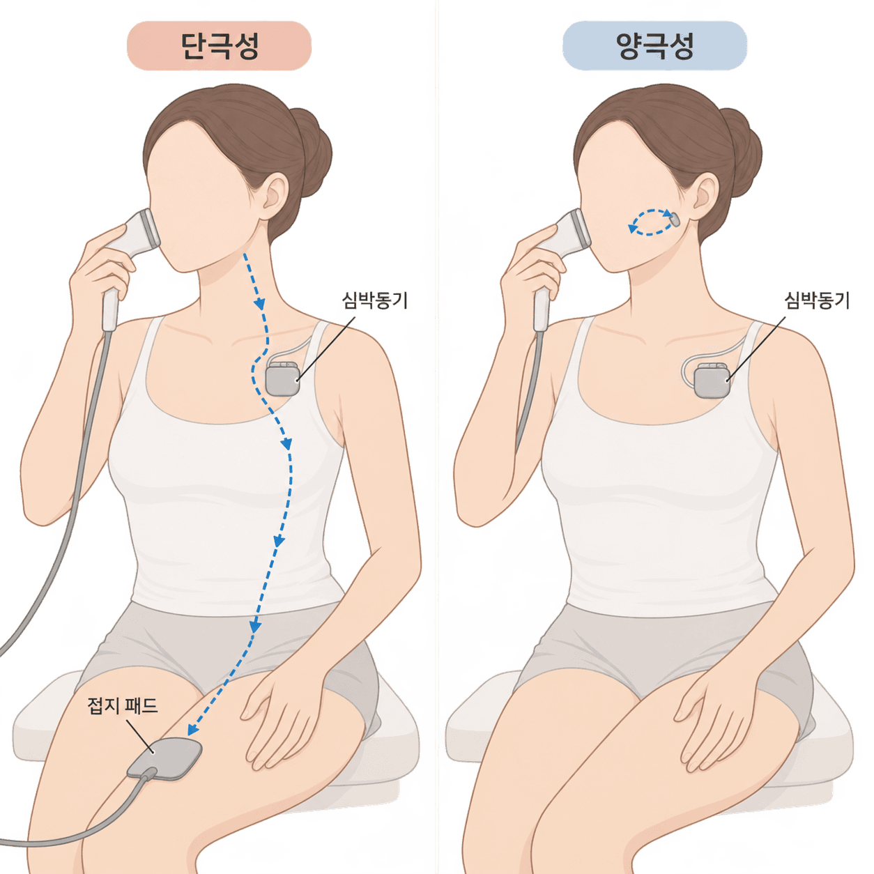 단극성은 전류가 몸을 지나 패드로 가고, 양극성은 팁 안에서 돌아요