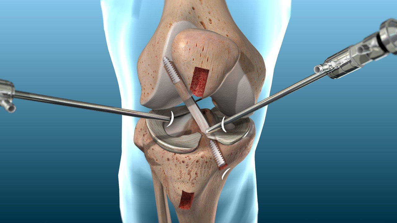 Advanced arthroscopy surgical suite at Arthomed clinic showcasing minimally invasive orthopaedic techniques.