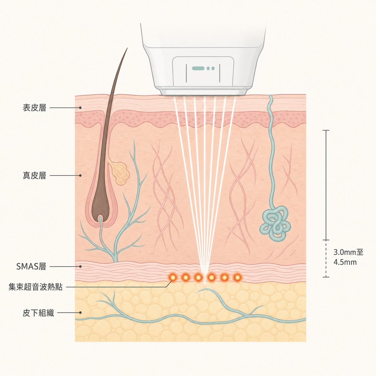 音波拉提HIFU能量穿透至SMAS層示意圖