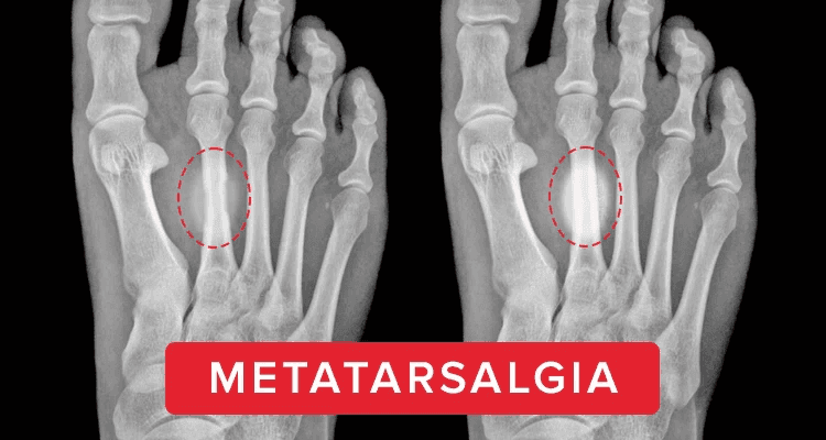 X-ray of Metatarsalgia