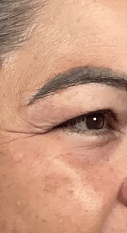 Eye aging treatment.