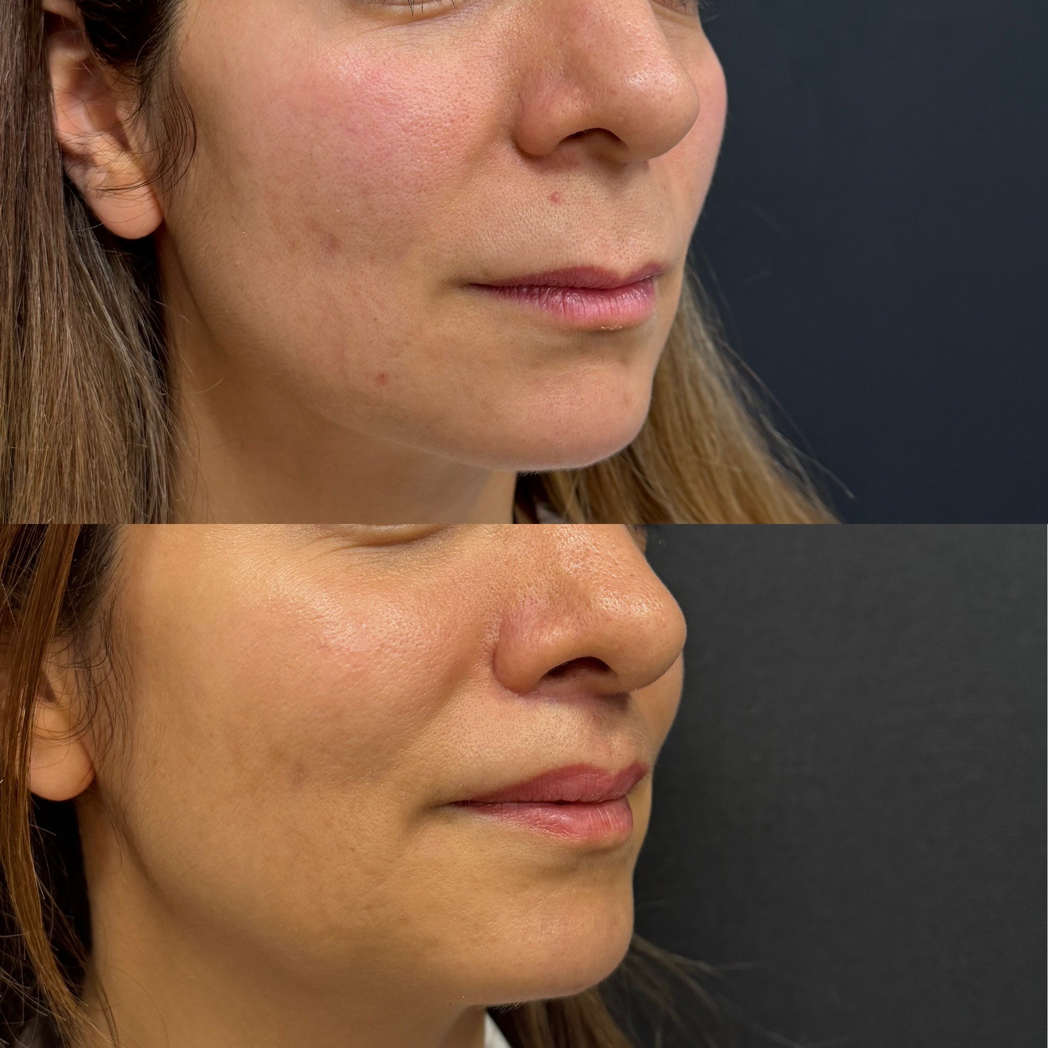 2 months post-op lip lift before after right oblique view