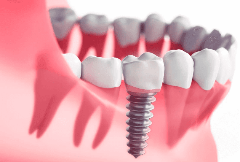 dental implants