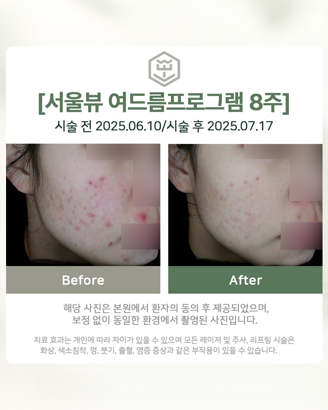 여드름프로그램 8주