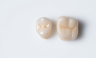 Two dental crowns placed side by side on a white background, showing realistic details and tooth-like coloration.