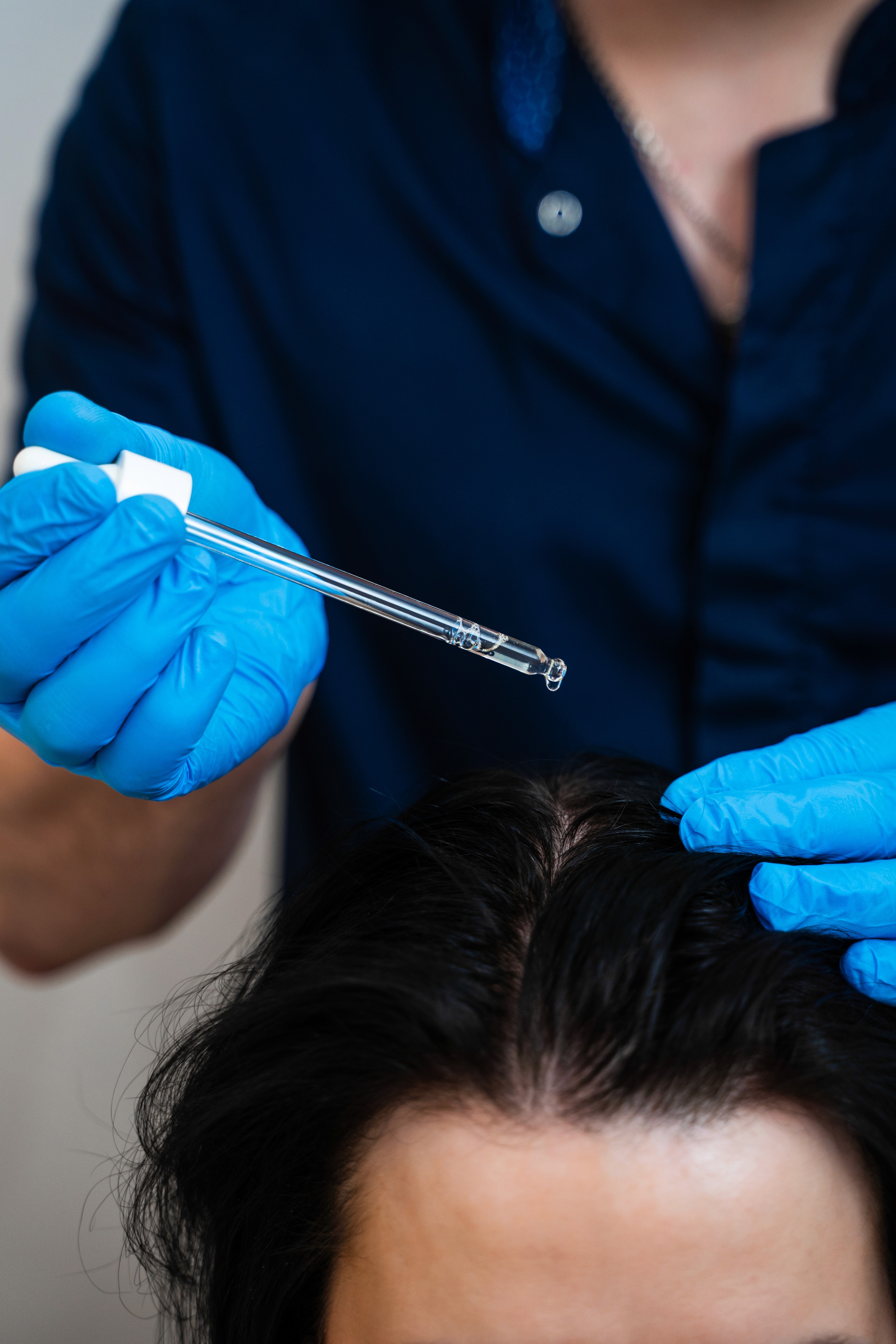 Tratamientos para efluvio telógeno en Terrassa, Heaven Clinics
