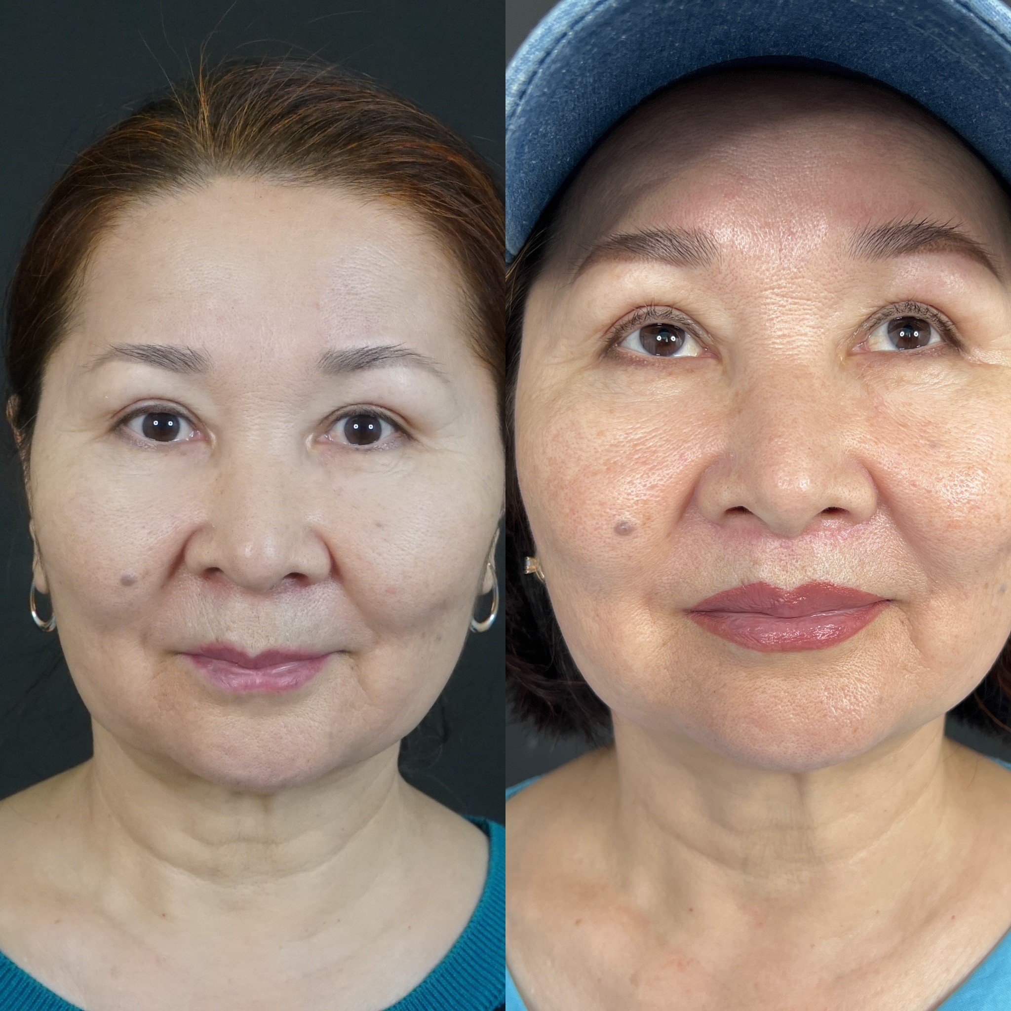 3 weeks result before after asian lip lift 