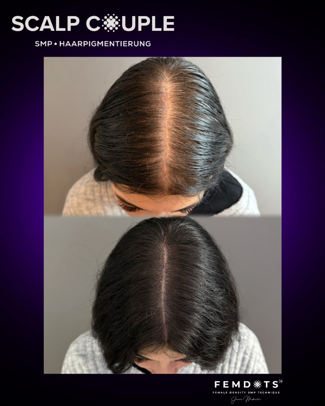 Haarpigmentierung Frau Vorher Nachher – SMP Ergebnis | Scalp Couple