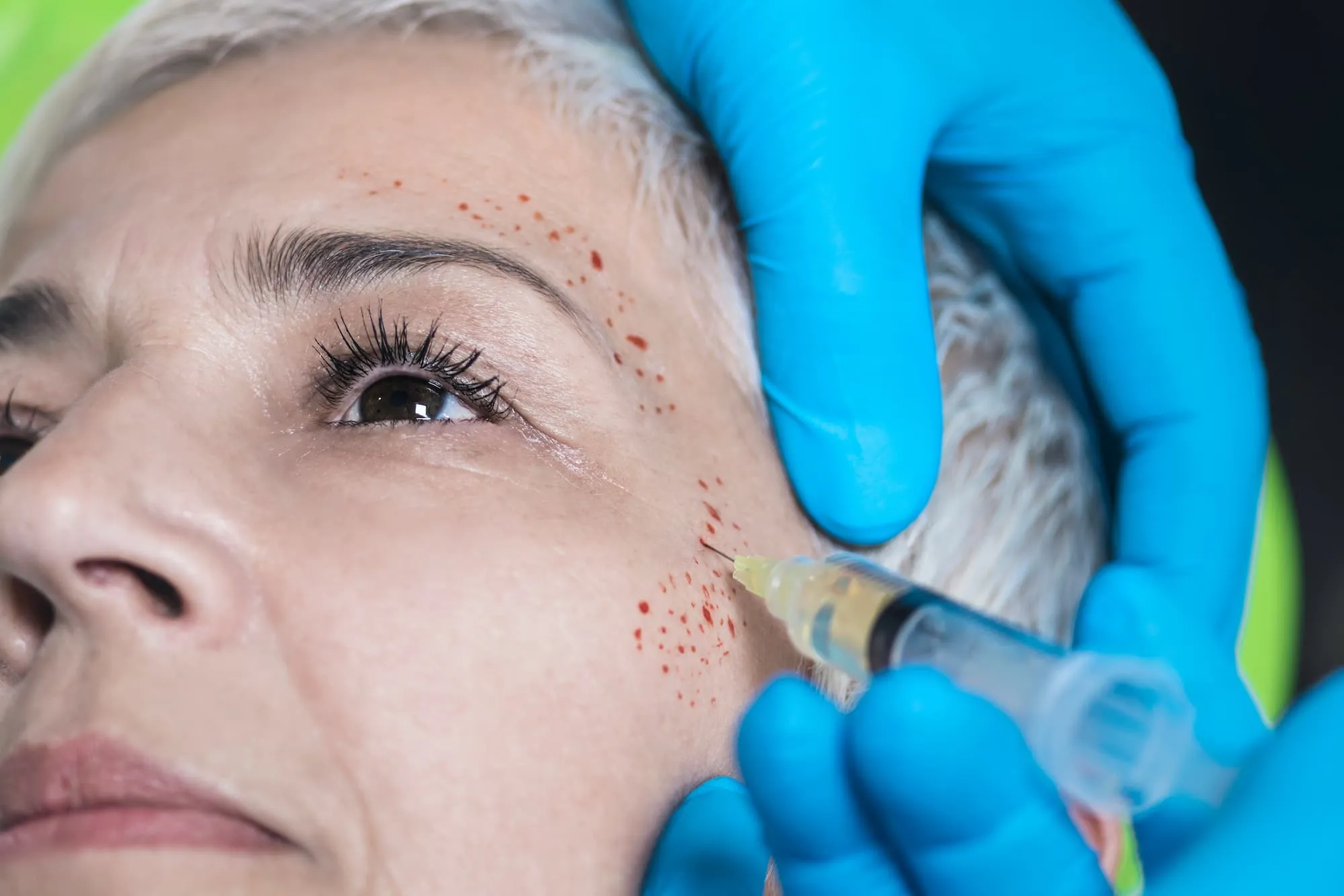 Close-up of PRP eye rejuvenation treatment using platelet-rich plasma injections to smooth wrinkles, reduce dark circles, and restore firmness under the eyes.