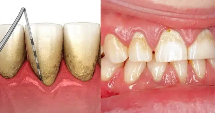 Periodontal and gum health treatment at COSDENT Smile Design