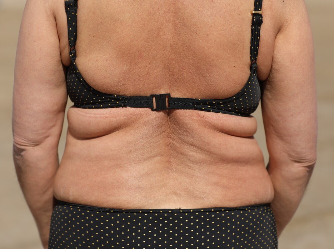 extra skin after weight loss