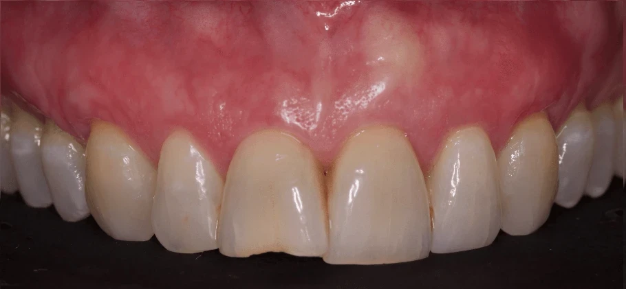 After treatment of receding gums at Bloor-Yorkville Periodontics