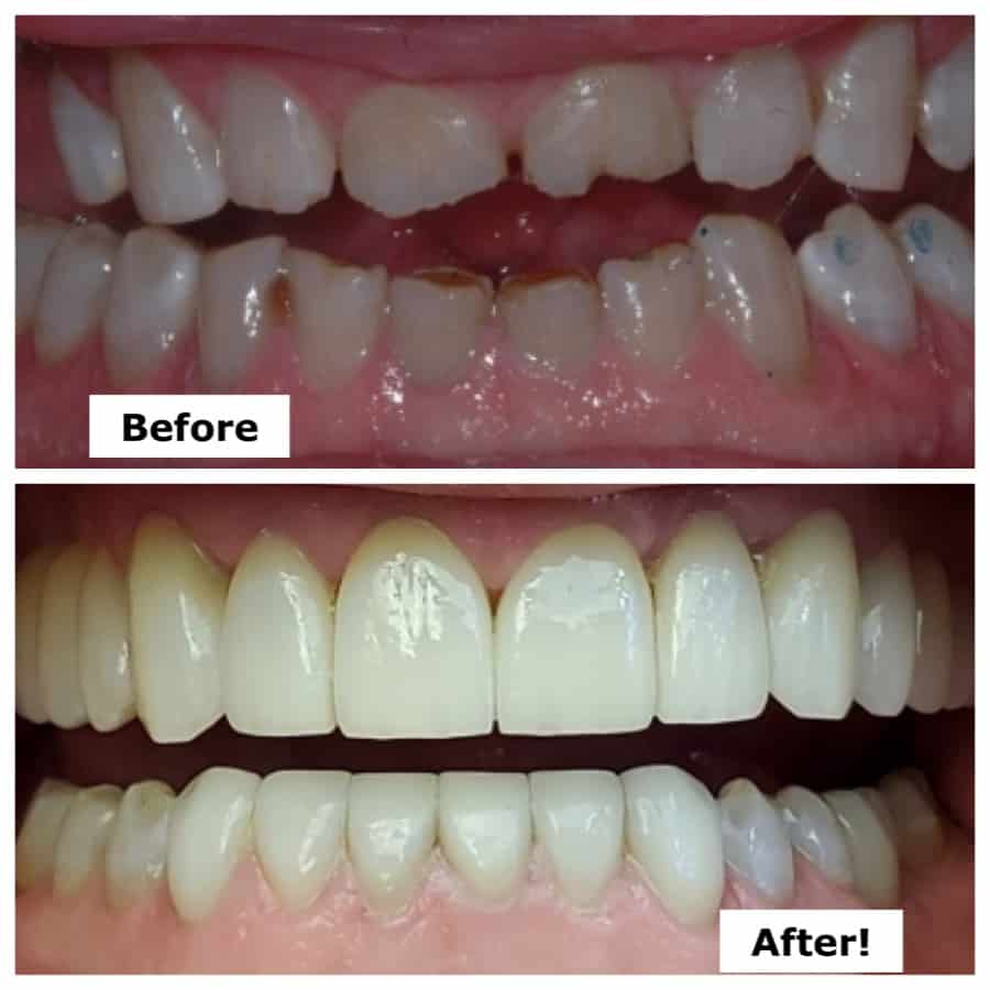Dental bonding composite resin cosmetic dentistry