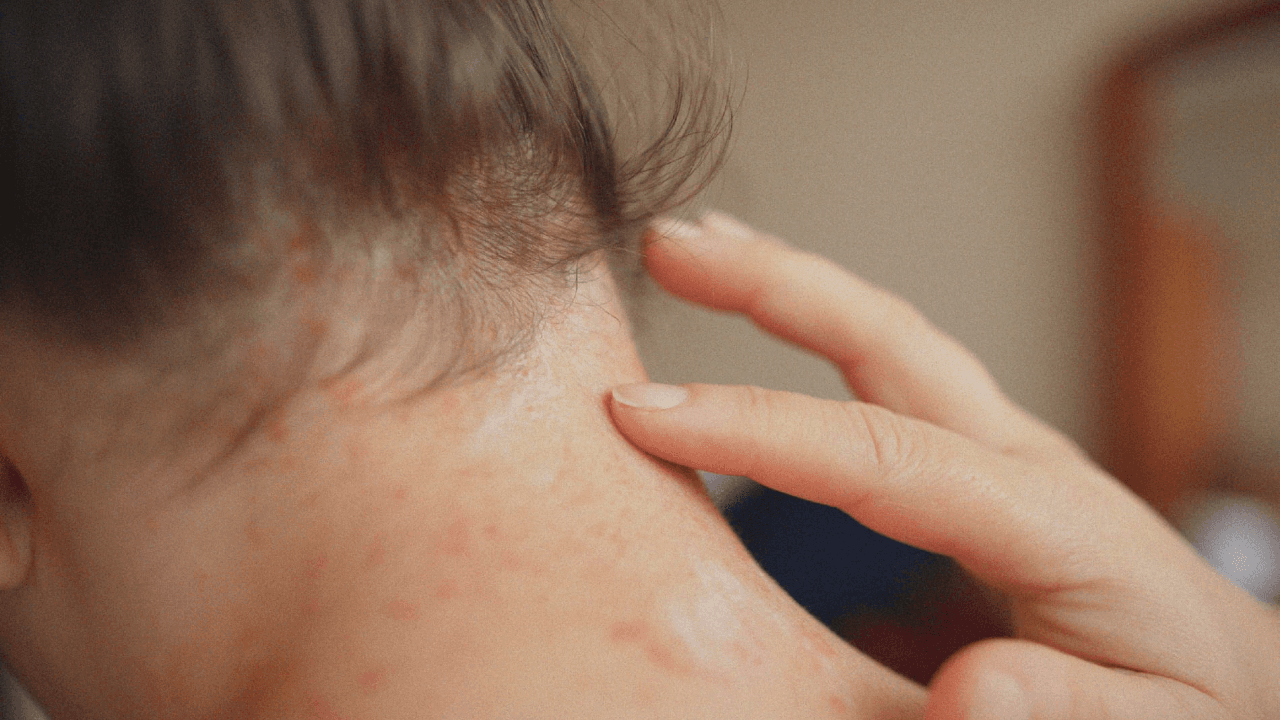 Personne se grattant la nuque, réaction cutanée visible