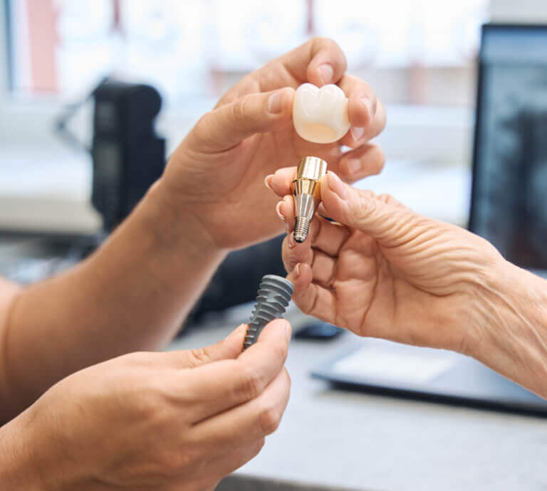 Implantes Dentários