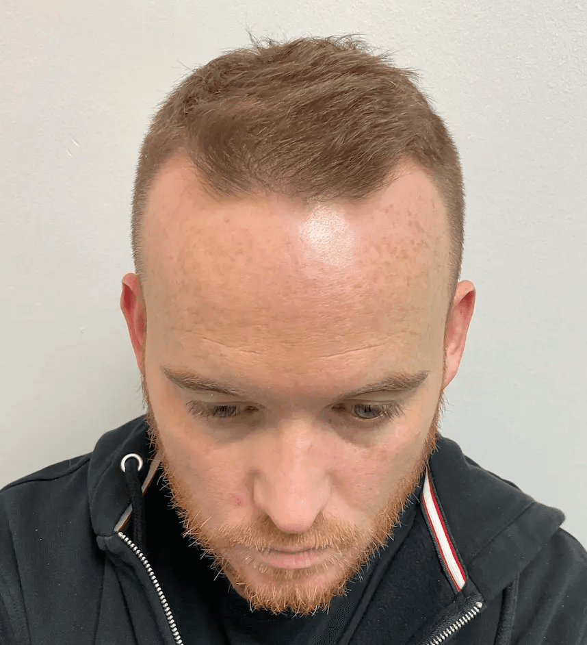 Before hair transplant – Ross's FUE Hair Transplant