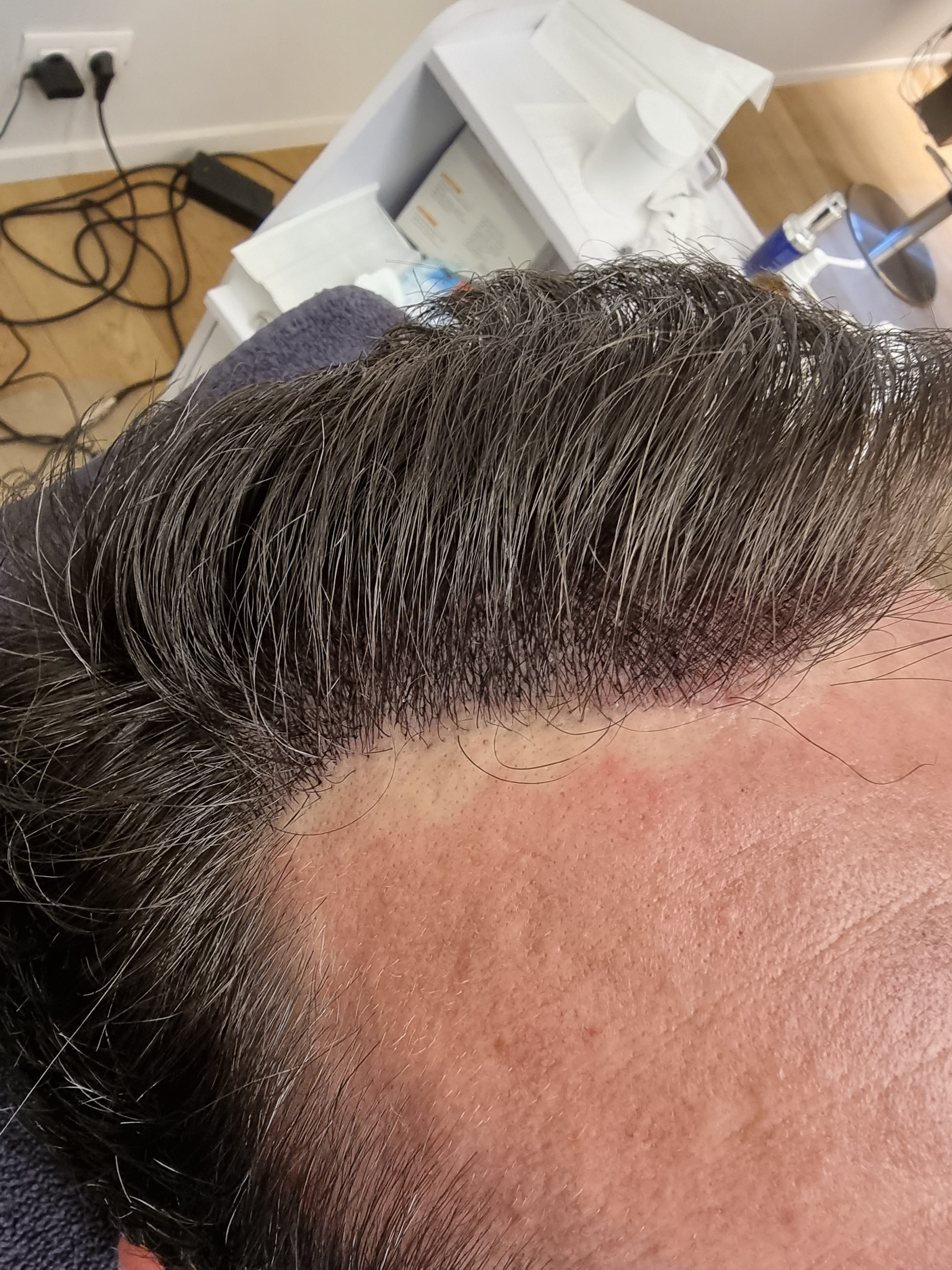 Haarlijn reconstructie