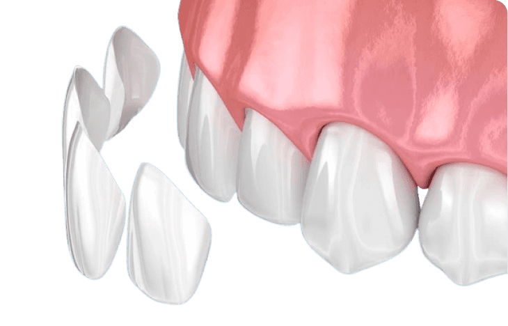 3D Model of veneers