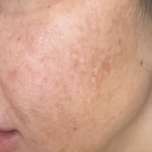 After chemical peel melasma treatment at The Vancouver Aesthetician — melasma visibly reduced and skin tone noticeably more even